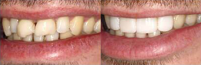 Before and after teeth