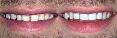 Before and after teeth