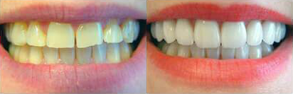 Before and after teeth