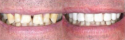 Before and after teeth
