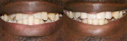 Before and after teeth