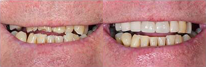 Before and after teeth