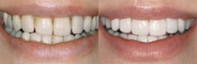 Before and after teeth