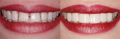 Before and after teeth