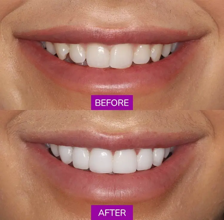 Before After 1
