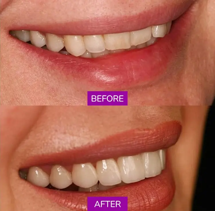 Before After 2