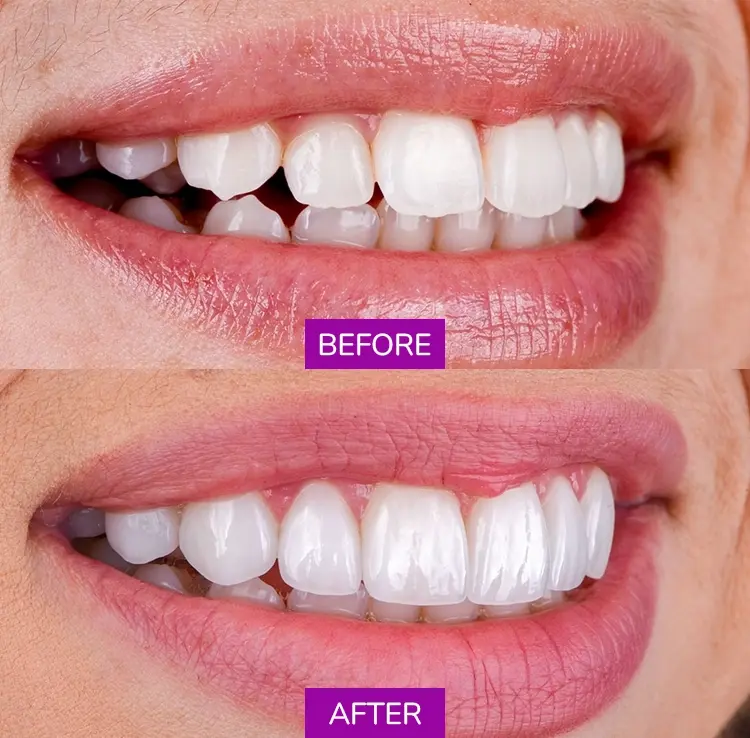 Before After 3