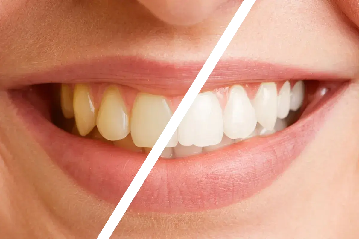 Philips Zoom WhiteSpeed Result